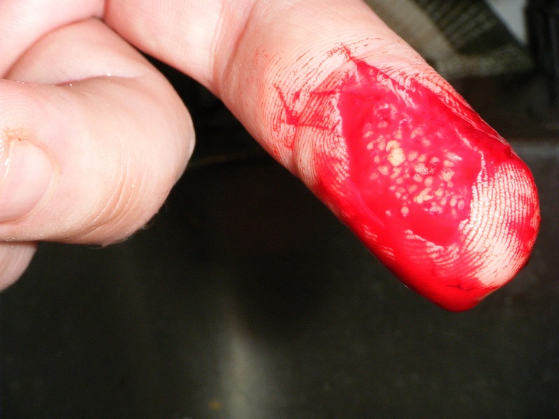 H. Galassi neteko keturių kairės rankos pirštų per nelaimingą atsitikimą birželio 21 dieną tame pačiame ežere... H. Galassi neteko keturių kairės rankos pirštų per nelaimingą atsitikimą birželio 21 dieną tame pačiame ežere...